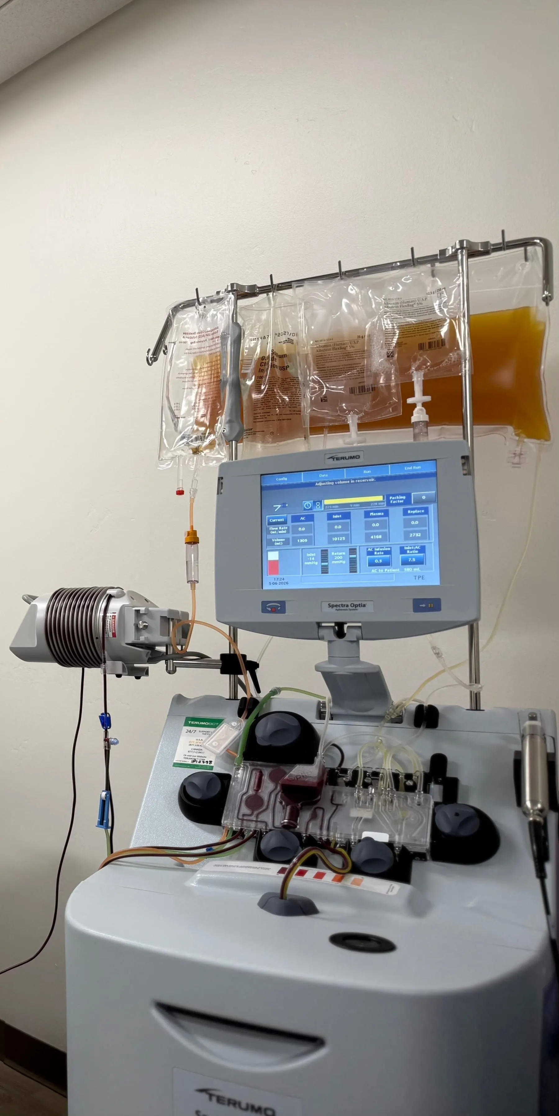 Avinity Health patient reclined in a treatment chair during a therapeutic plasma exchange (TPE) session, with a line in each arm.