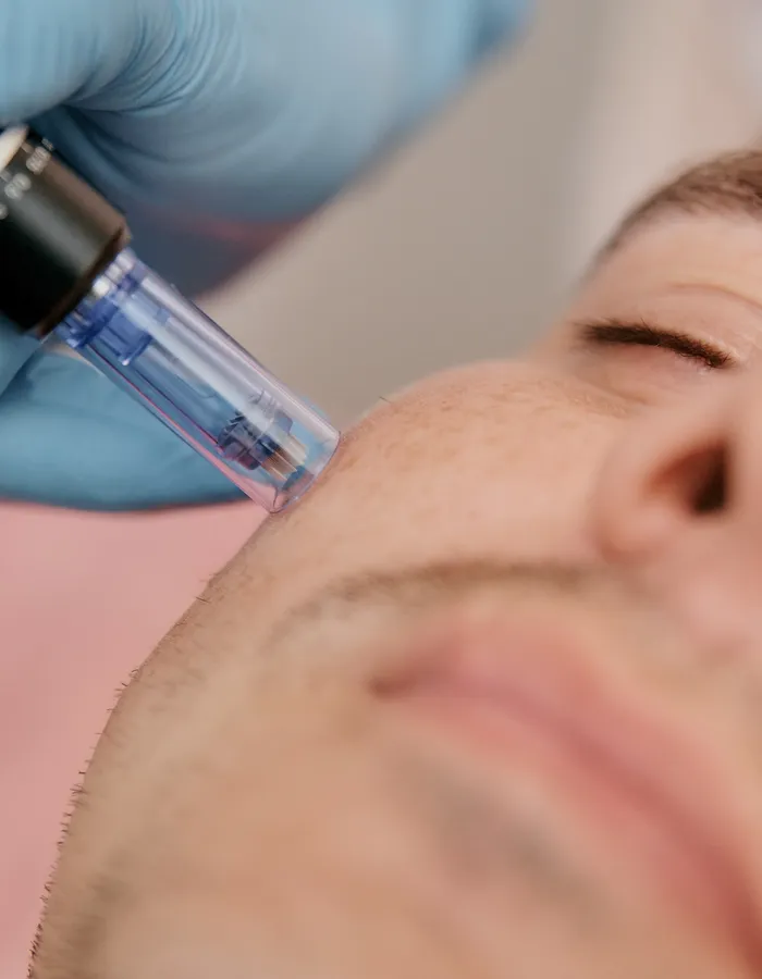 Patient assessment for exosome microneedling at Avinity Health Scottsdale