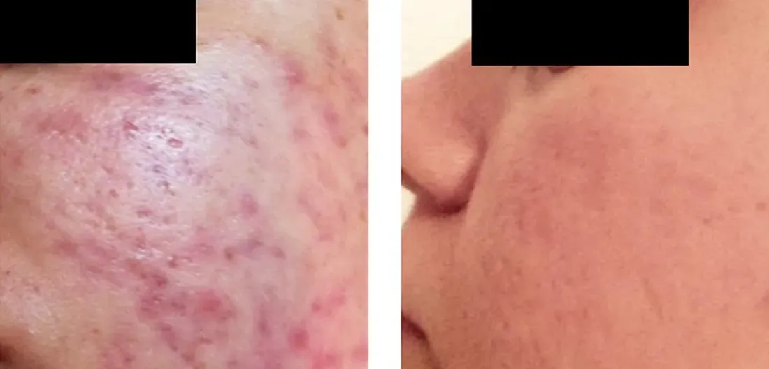 Before and after medical-grade microneedling for acne scarring on cheek