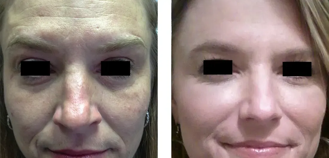 Before and after microneedling for forehead texture and tone