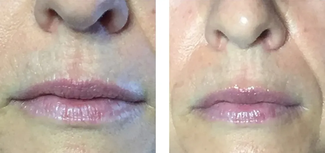 Before and after microneedling for fine lines around the mouth