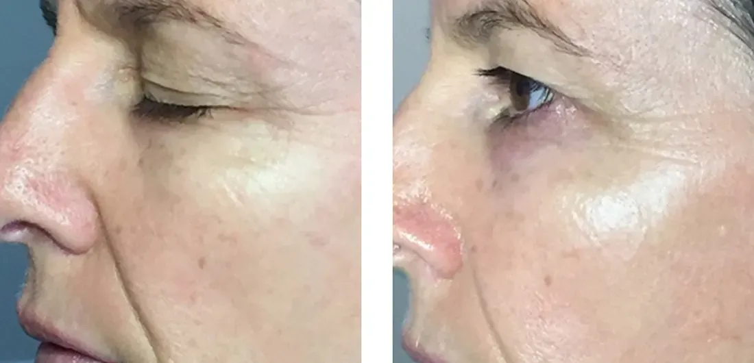 Before and after microneedling showing improved skin texture and tone, side profile