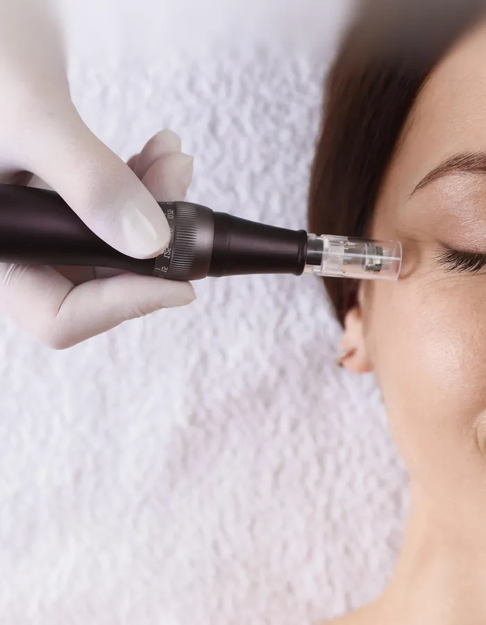 Microneedling results: improved skin texture and tone at Avinity Health