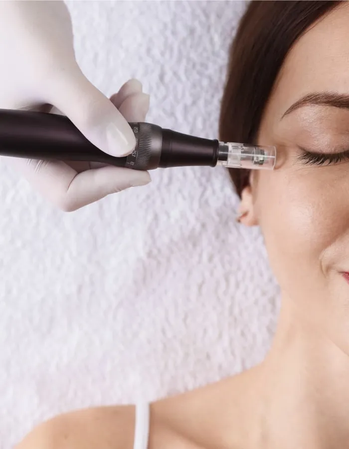 Medical-grade microneedling pen treating skin texture at Avinity Health near Kierland