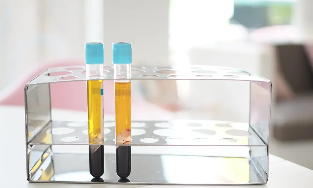Spun blood tubes in a rack showing golden platelet-rich plasma separated above the red cells, the first step in preparing a natural under-eye filler alternative at Avinity Health Scottsdale