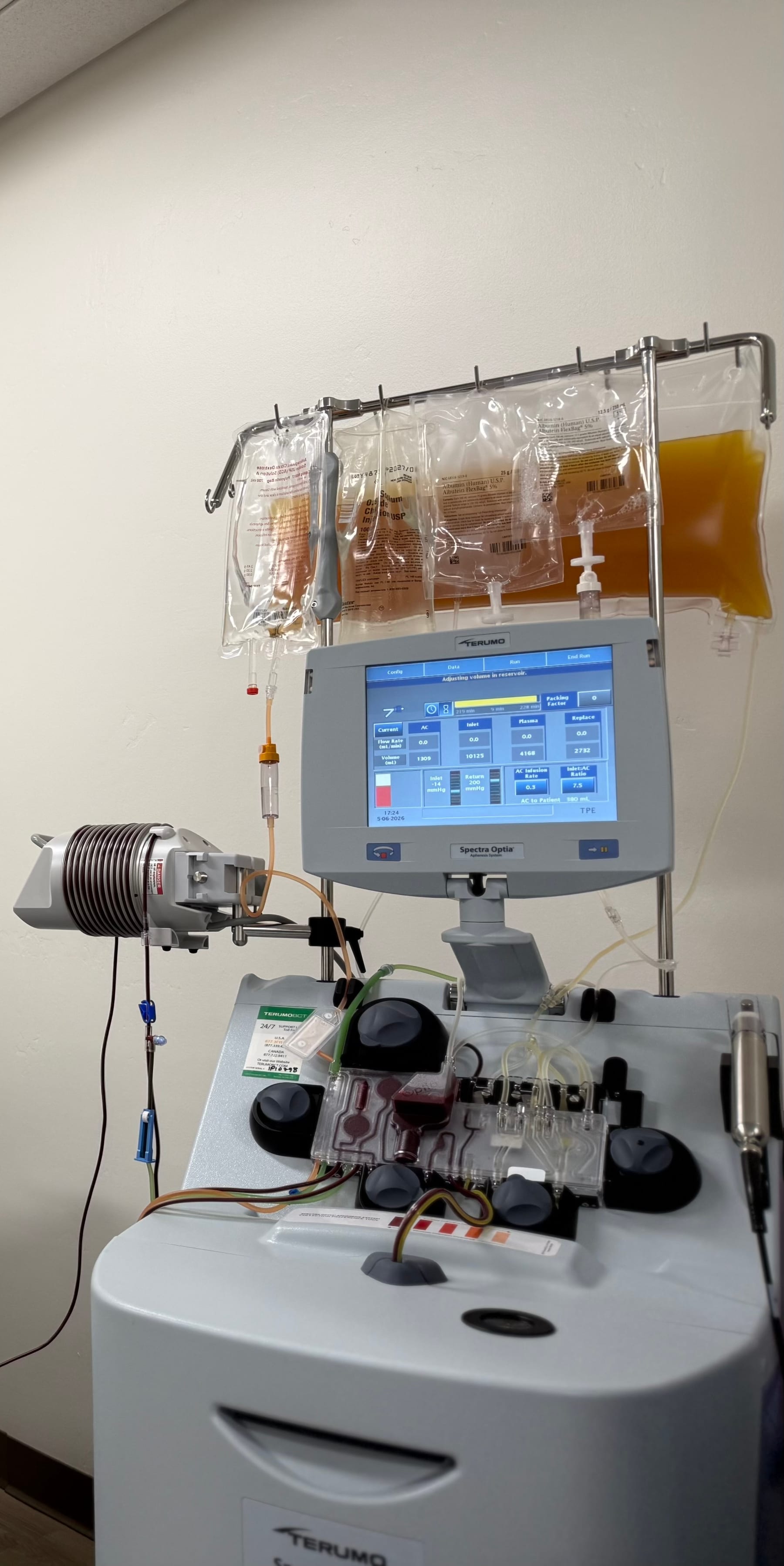 Avinity Health patient reclined in a treatment chair during a therapeutic plasma exchange (TPE) session, with a line in each arm.