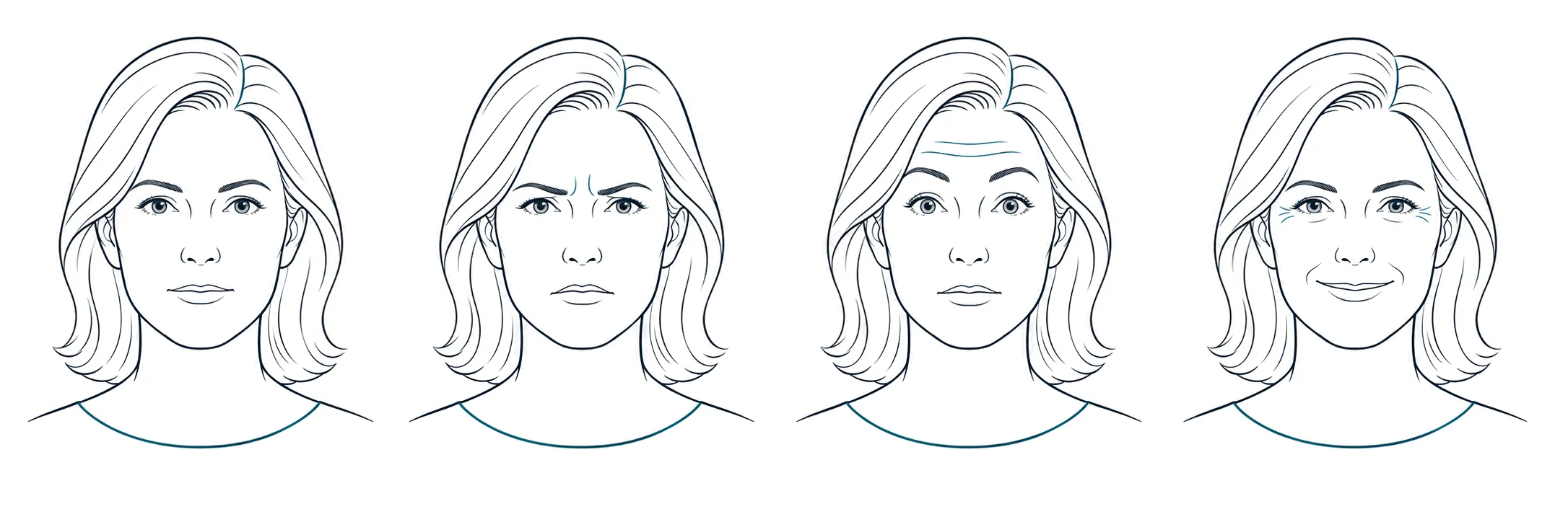 Illustration of a woman's face in four panels showing a Botox facial assessment: at rest, frowning, raising the eyebrows, and smiling.