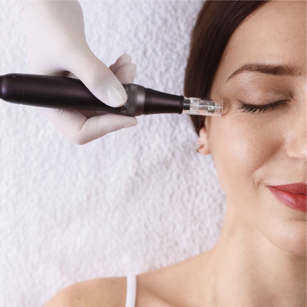 Microneedling results — improved skin texture and tone at Avinity Health